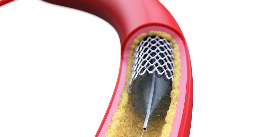 未破裂動脈瘤の場合