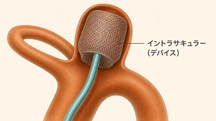 脳動脈瘤について - 日本脳神経血管内治療学会 : JSNET